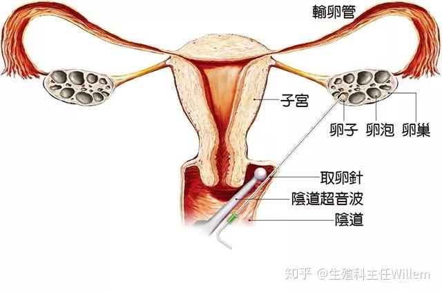 湖南长沙男同试管供卵机构排名生子